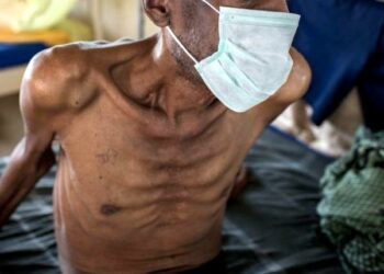 High TB Mortality In Nigeria: A Call To Action